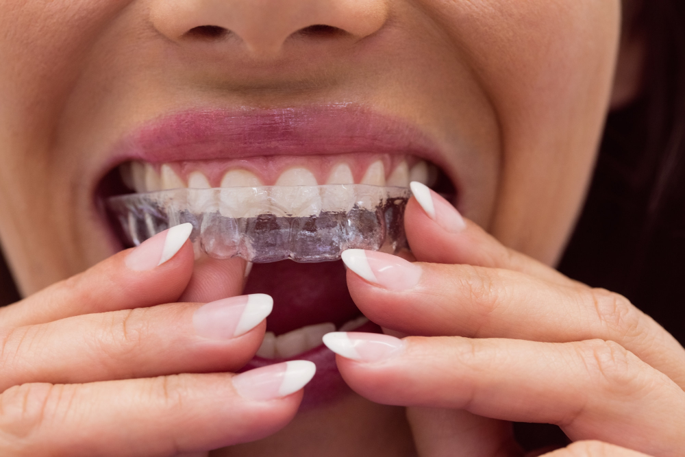 Cost of Invisalign in Canada: Is It Right for You?