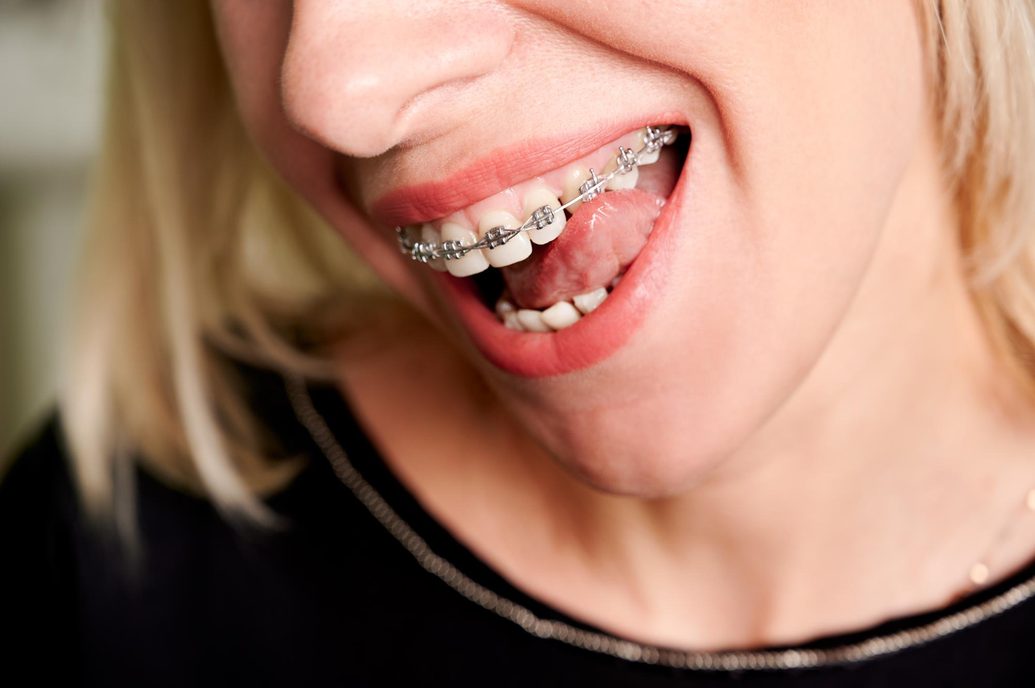 Orthodontic Options for Adults: Beyond Traditional Braces