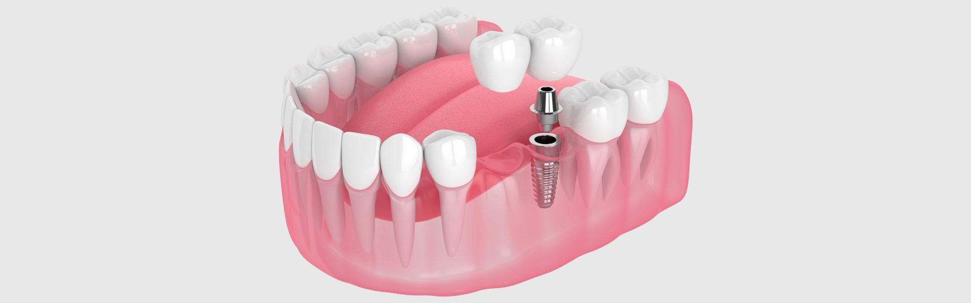 Some Facts about Dental Bridges