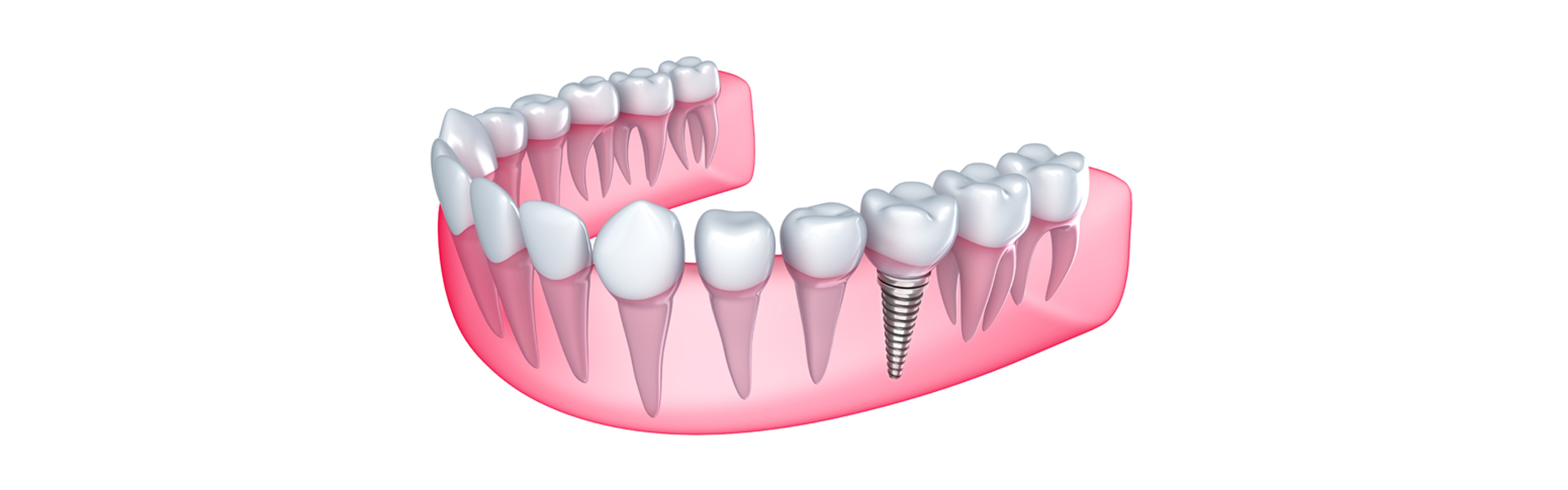 Implant Dentistry for Missing Teeth
