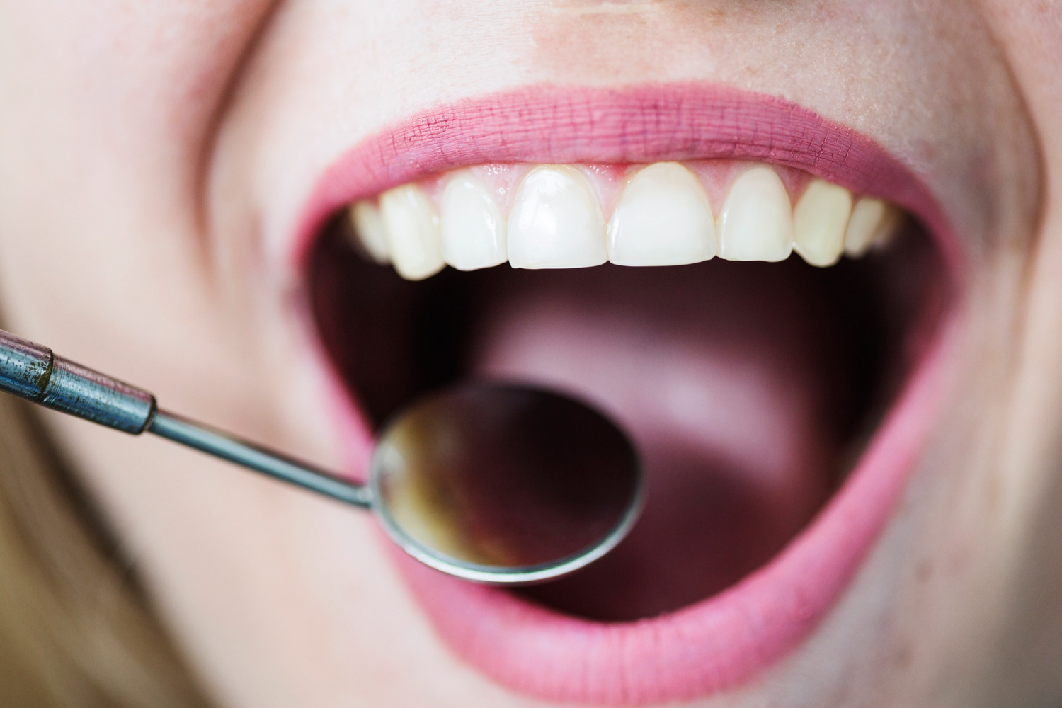 White Spots On Teeth: How To Get Rid Of Them