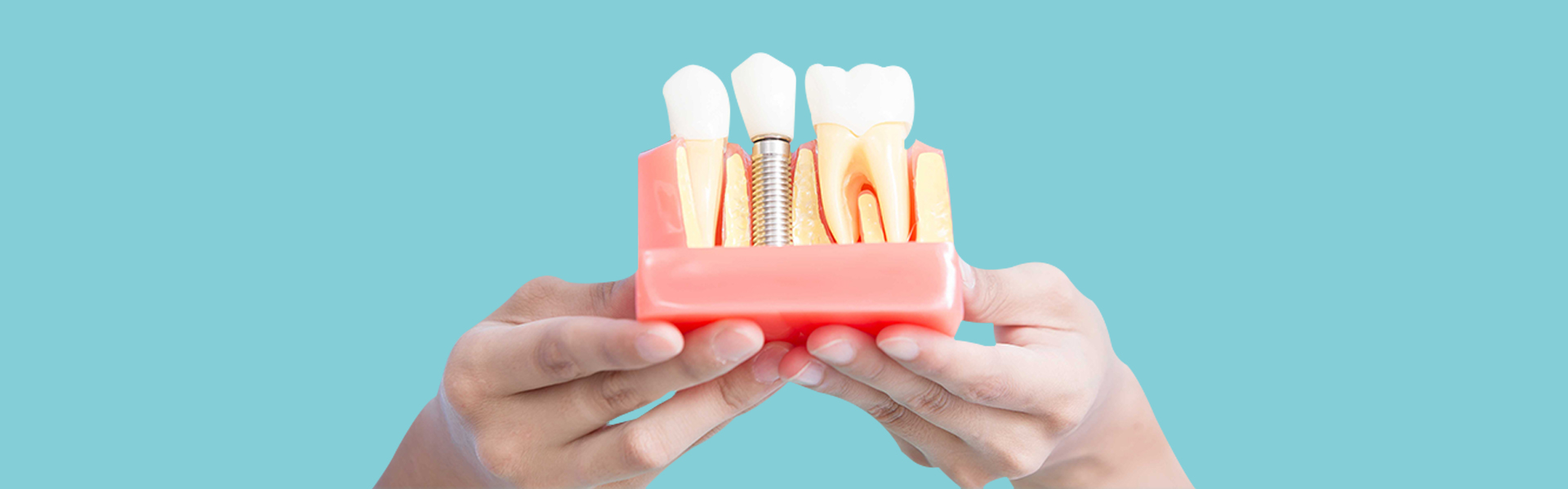 What You Should Do for Dental Implant Success