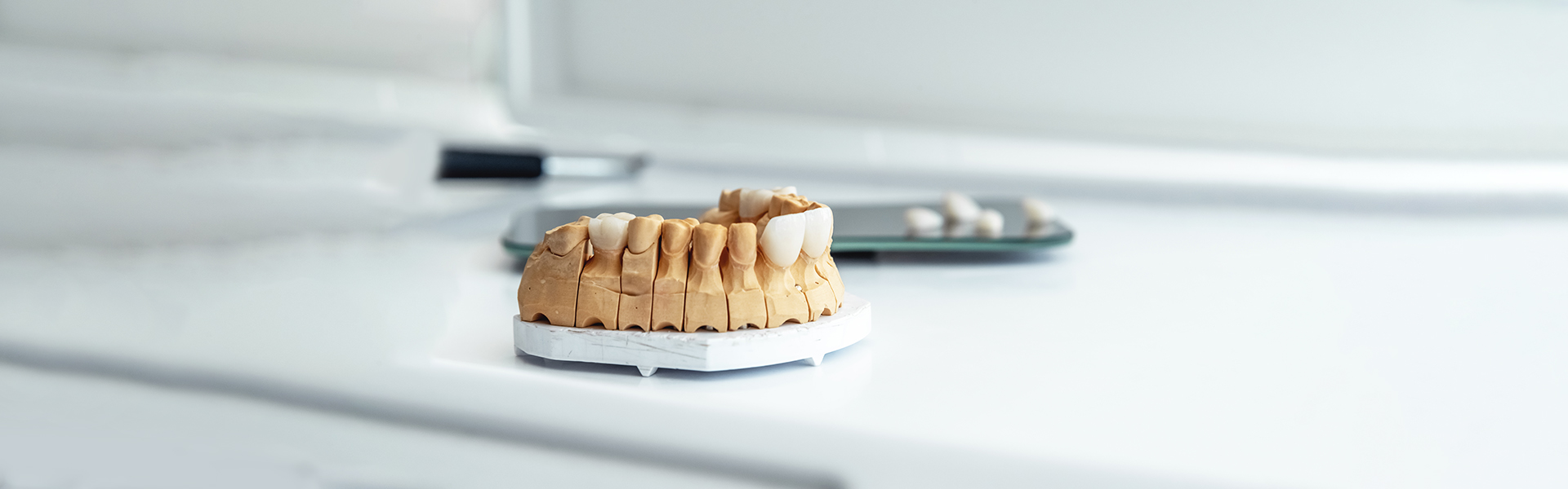 Can Veneers Fall Off