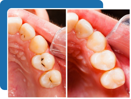 Amalgam Free Fillings