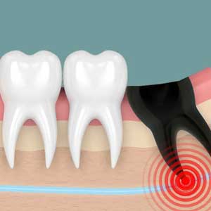 Wisdom Teeth Extraction