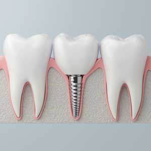 Bridges & Dental Implants