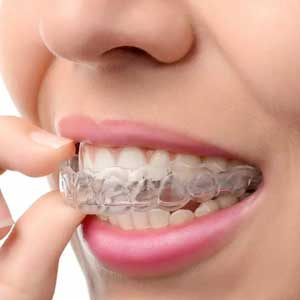 Invisalign