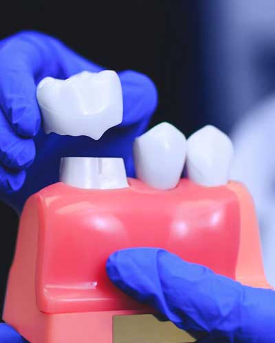 Dental Crowns and Caps
