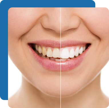 Full Mouth Reconstruction