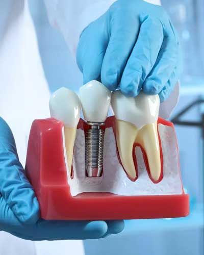 Bridges & Dental Implants