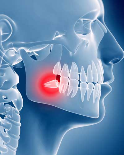 Wisdom teeth extraction